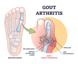 What Is Chronic Gout?