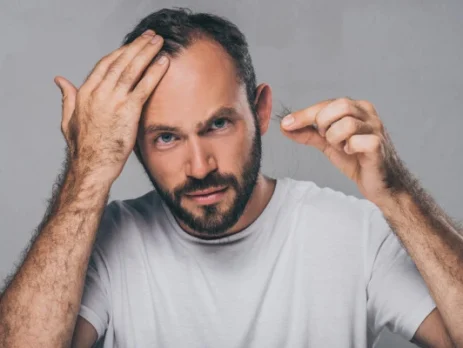 Now Enrolling: Alopecia Clinical Trial – Is This Hair Loss Study Right for You?