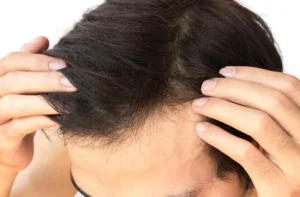 
Hair Regrowth and the Potential for Recovery
