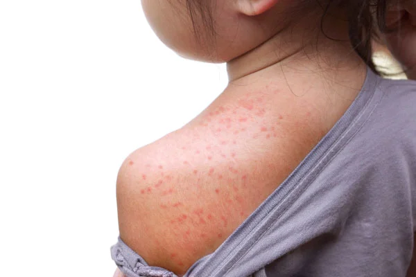Child's shoulder and upper back with a red, blotchy rash on the skin surface of a young person’s shoulder area.